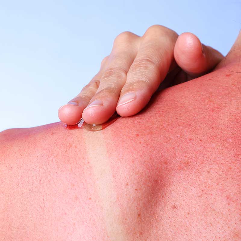 Sunburn and burn treatment