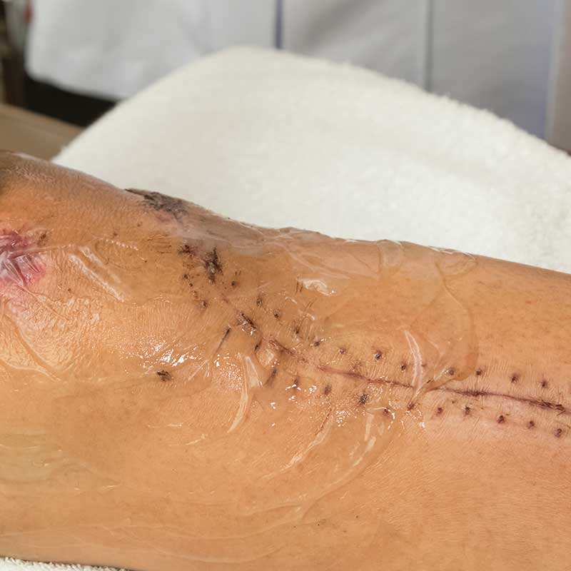 Surgical sites and wound care