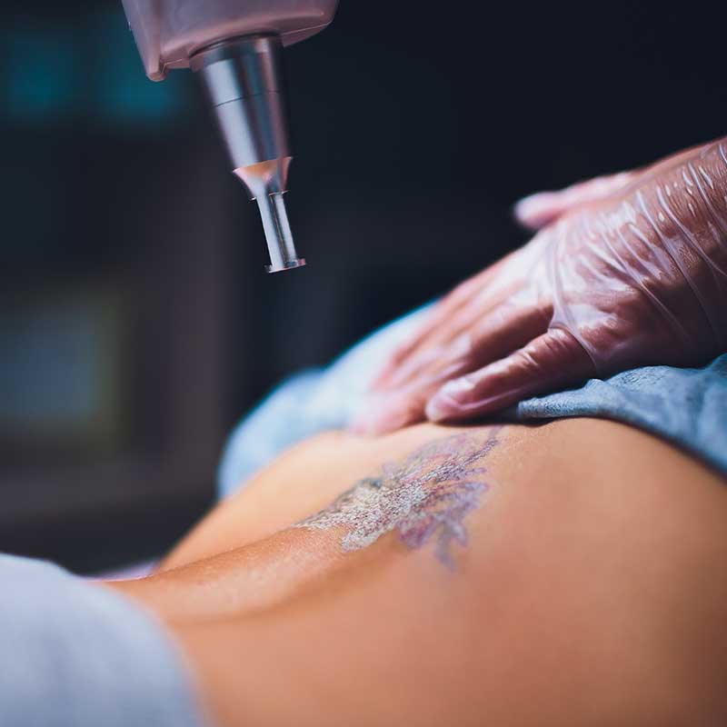 Tattoo removal healing